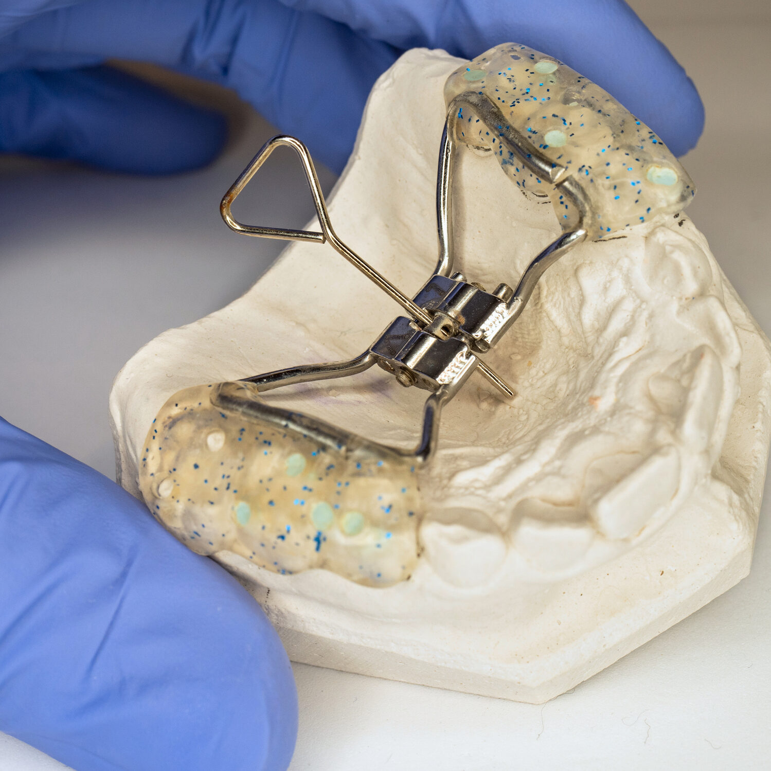 Children Braces. Test Hyrax Rapid Palatal Expander