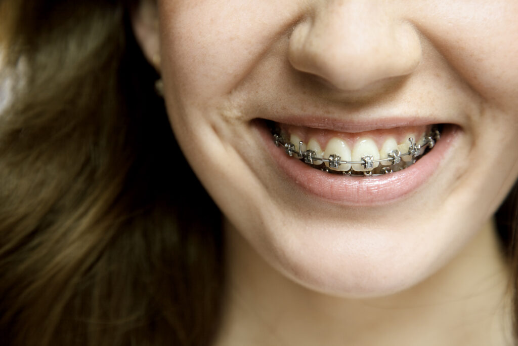Dental Braces